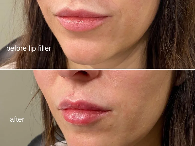 Lip framing before and after at GLOW Aesthetic Clinic, Bismarck