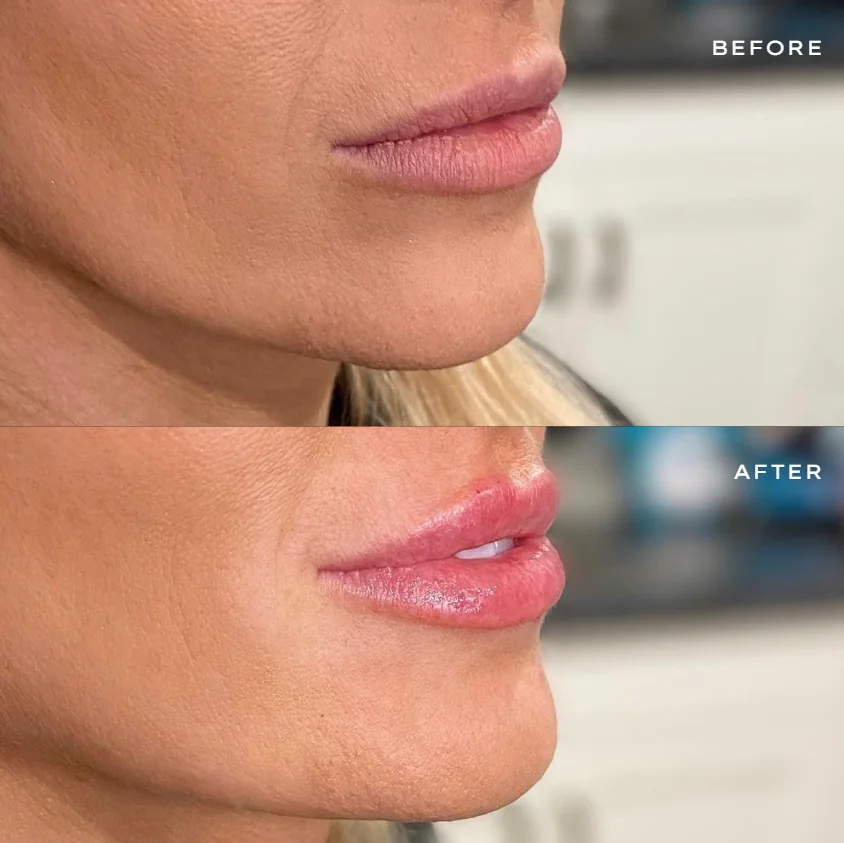Lip framing before and after at GLOW Aesthetic Clinic Bismarck — natural lip filler result