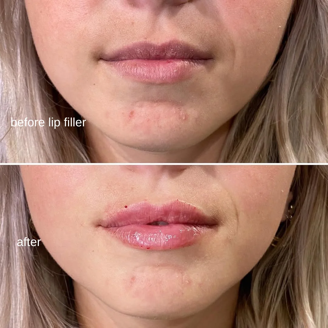 Lip filler before and after at GLOW Aesthetic Clinic — improved Cupid's bow and definition