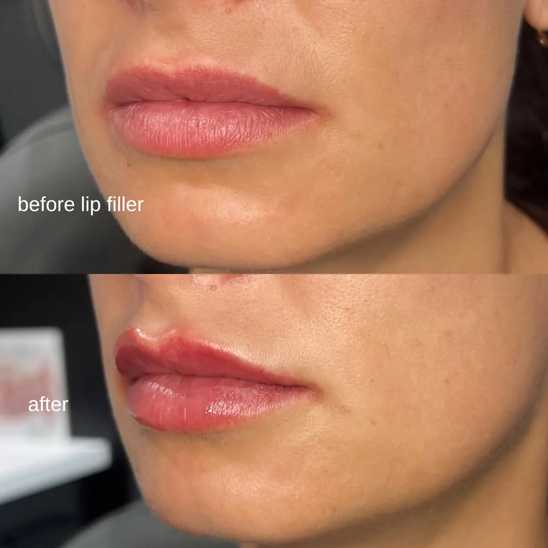 Lip framing before and after — balanced, natural-looking lip enhancement at GLOW Aesthetic Clinic Bismarck
