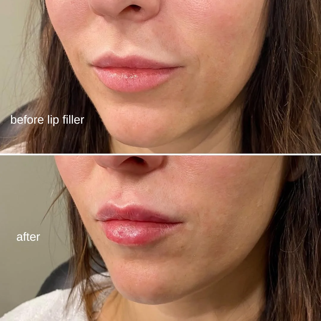 Lip framing before and after at GLOW Aesthetic Clinic, Bismarck — natural lip filler results