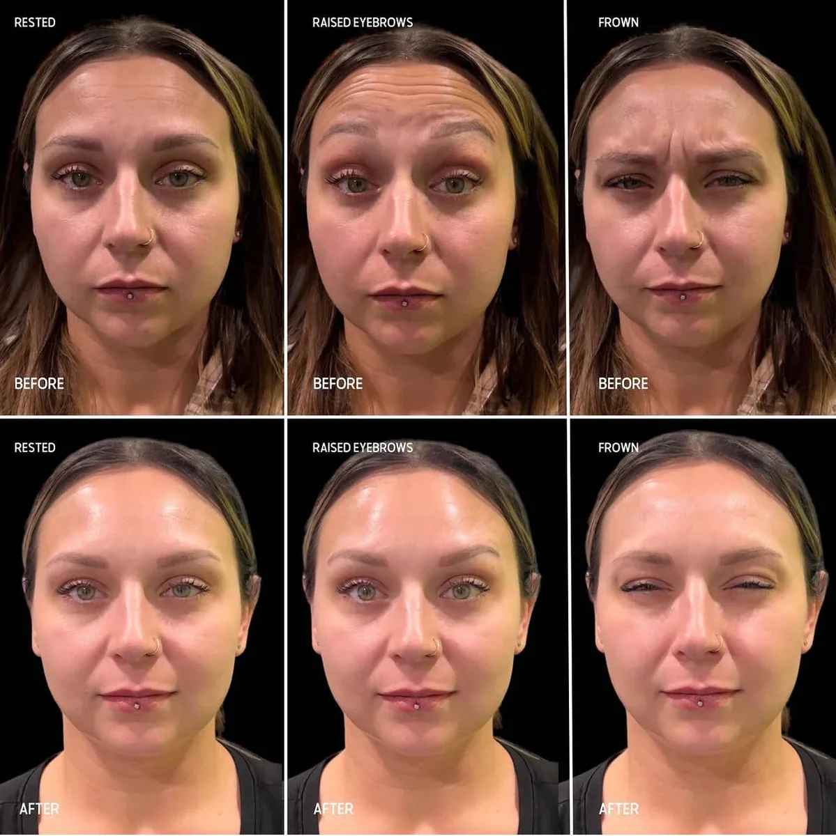 Tox / Botox before and after at GLOW Aesthetic Clinic, Bismarck — softer forehead and frown lines while maintaining natural expression