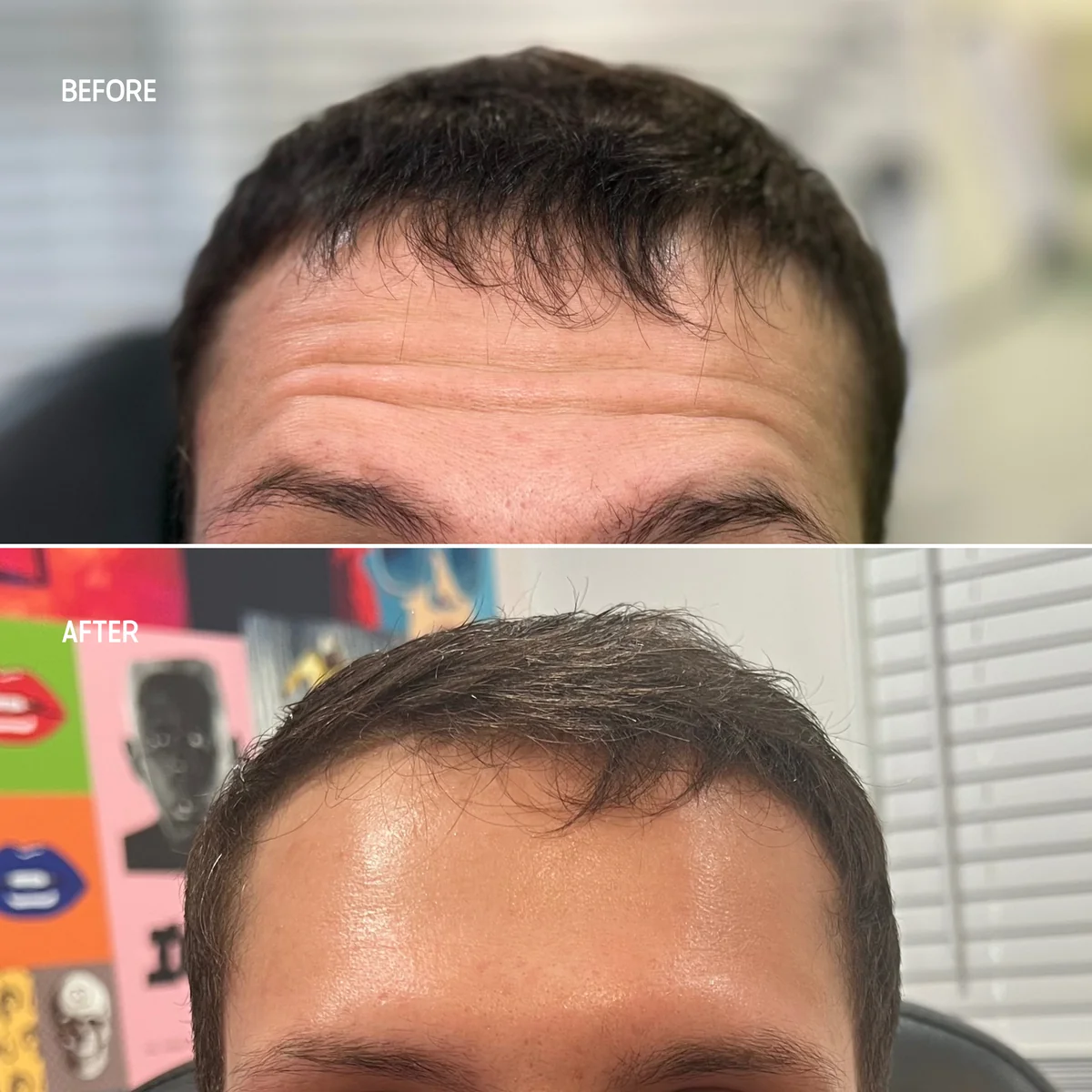 Male Botox before and after at GLOW Aesthetic Clinic Bismarck — forehead line softening in male first-time patient