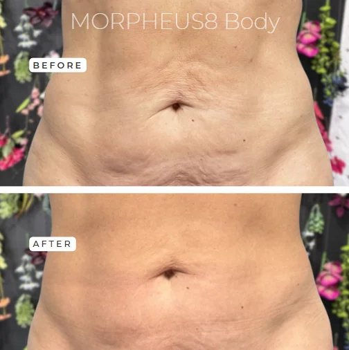 Morpheus8 Body before and after at GLOW Aesthetic Clinic Bismarck — abdominal skin tightening result